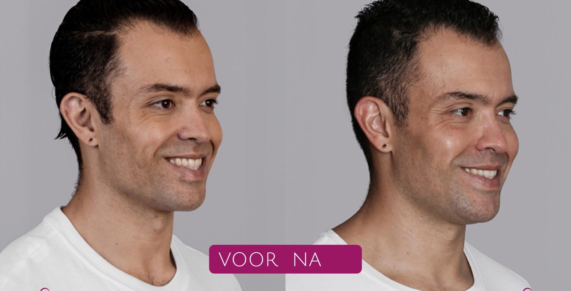 Sculptra®---Post---Echte-patiënt-foto’s-(voor-&-na)--Farney---01