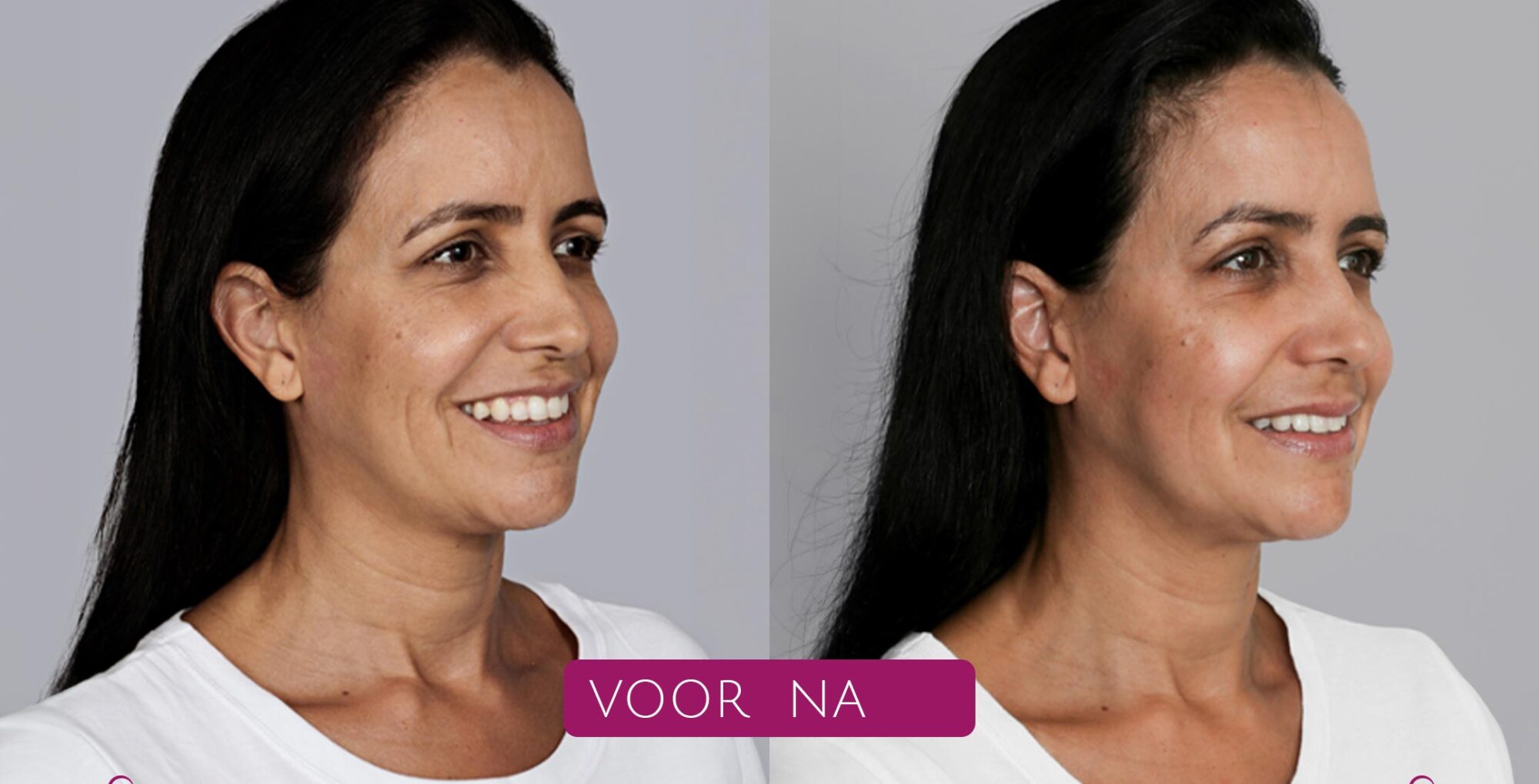 Sculptra®---Post---Echte-patiënt-foto’s-(voor-&-na)--Mirna---01