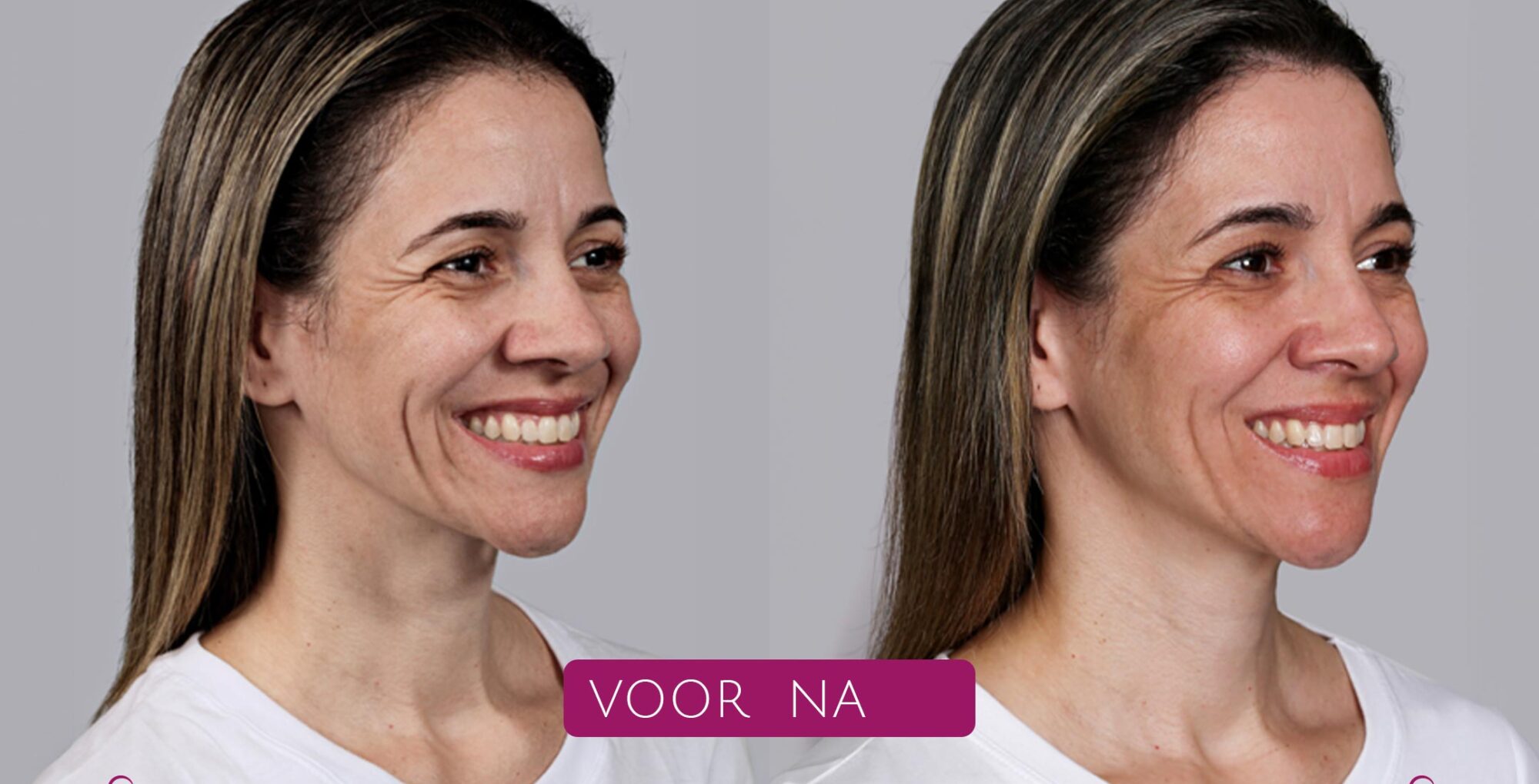 Sculptra®---Post---Echte-patiënt-foto’s-(voor-&-na)--Tracy---01