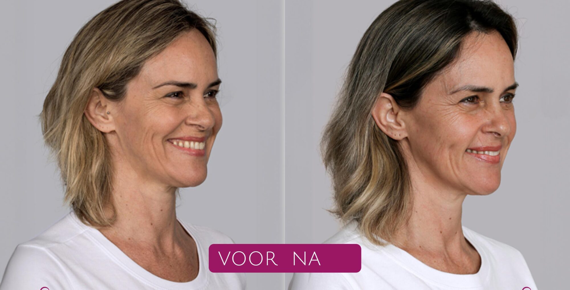Sculptra®---Post---Echte-patiënt-foto’s-(voor-&-na)--Vivian---01