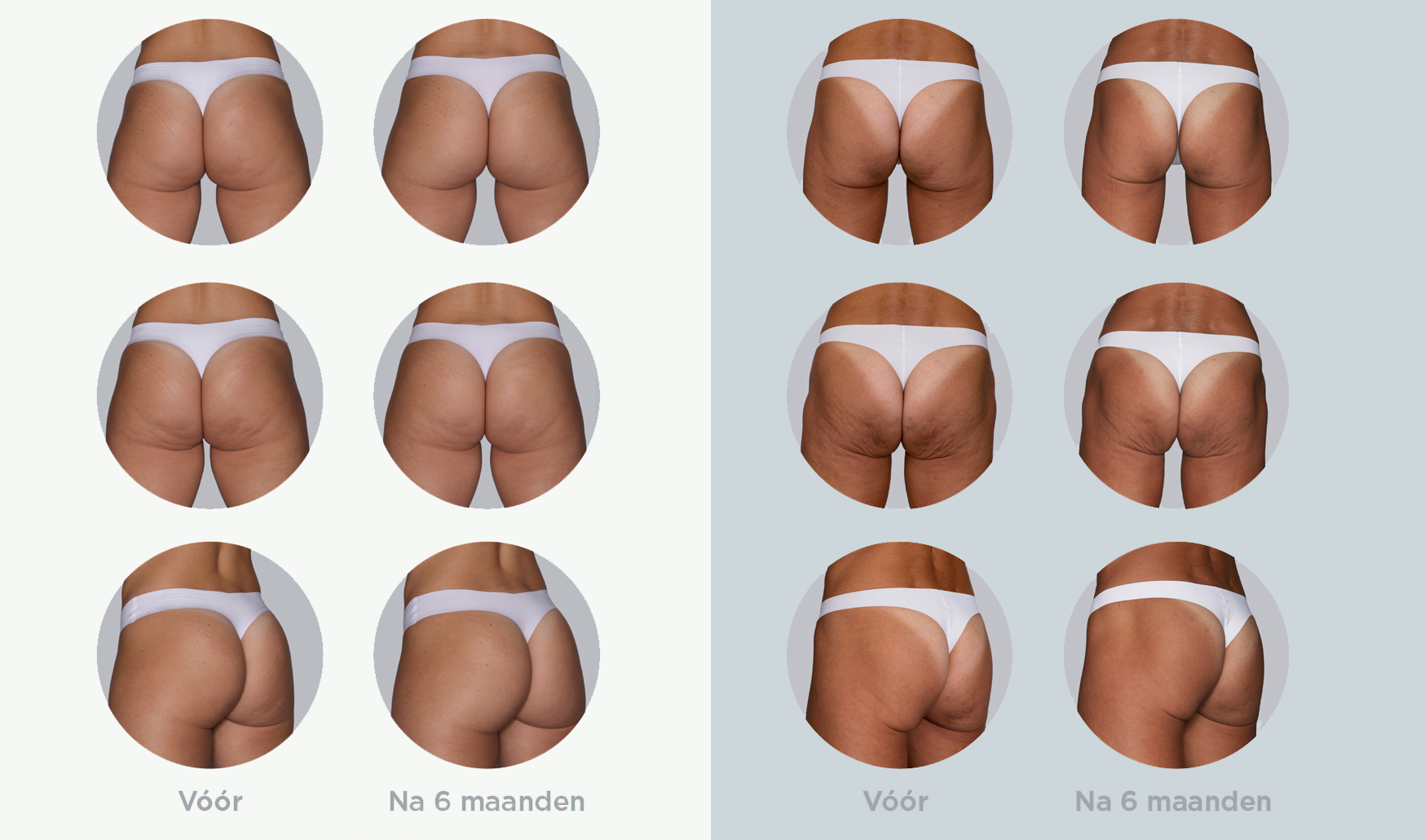 Sculptra resultaten
